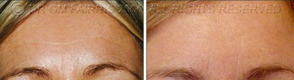 Anti Wrinkle Injection - Botox Forehead
