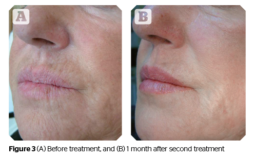 Profhilo before and after