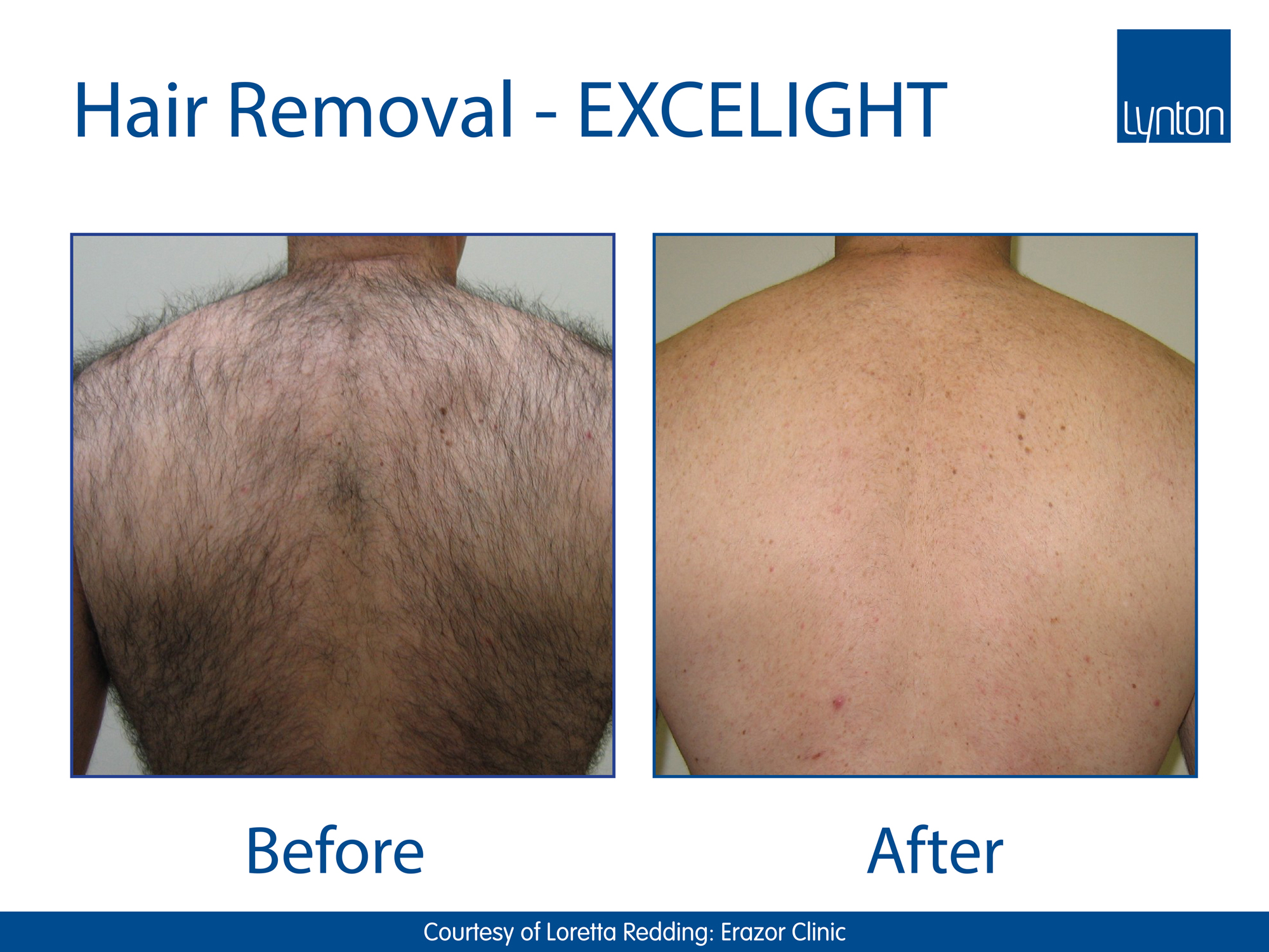 EXCELIGHT – Hair-Removal Back